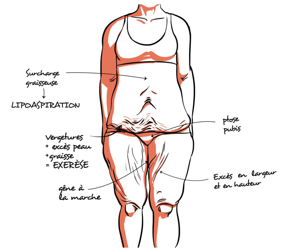 Plastie abdominale - MCE Rouen - Dr Pérignon - Dr Surlemont